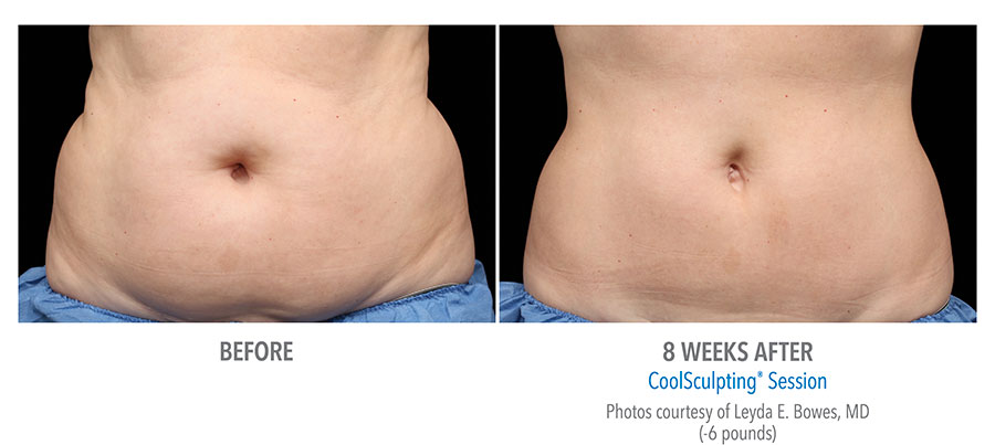 CoolSculpting Before After Images