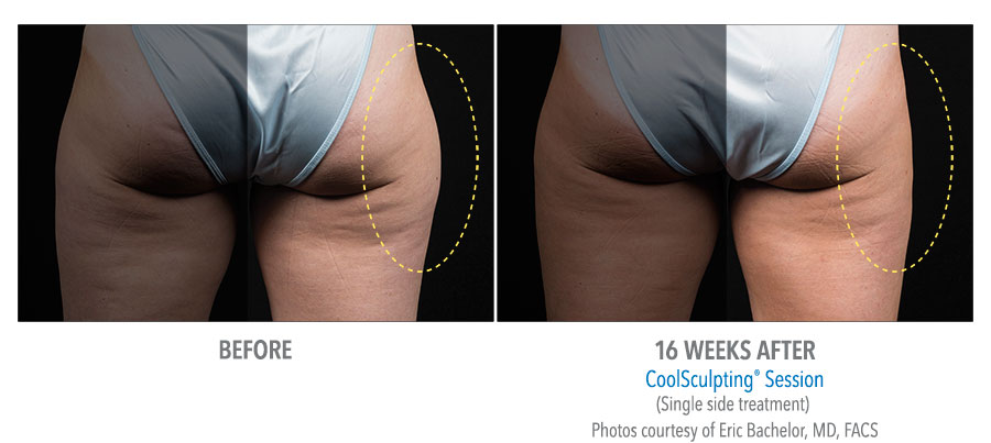 CoolSculpting Before After Images