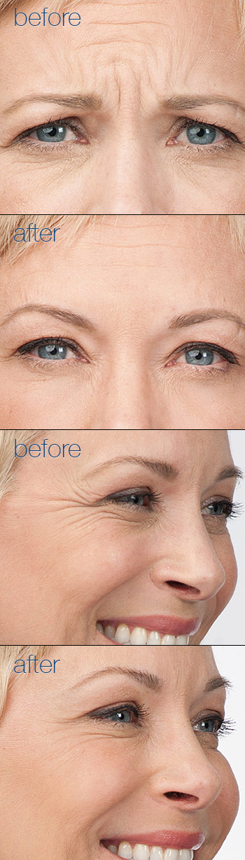 Botox Dermal Fillers