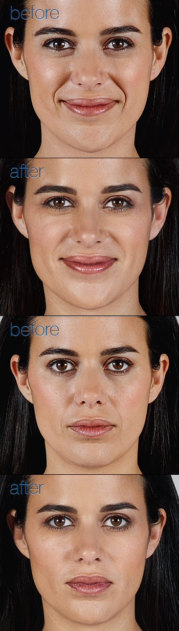 Botox Dermal Fillers